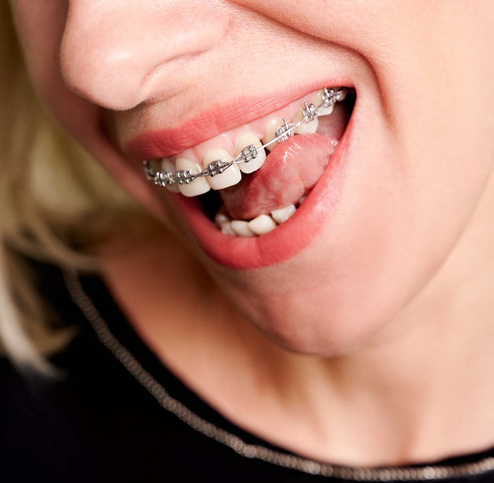 Brackets autoligado en Cancún en iSMile Dental Design Studio