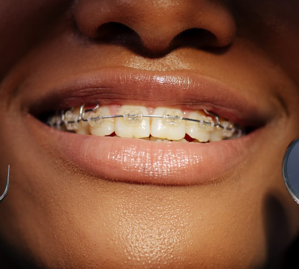 Brackets estéticos en Cancún, en iSmile Denta Design Studio