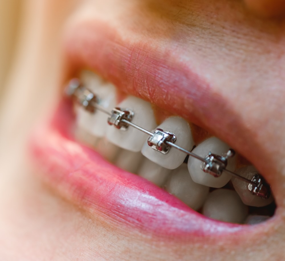Brackets metálicos en Cancún, en iSmile Dental Design Studio