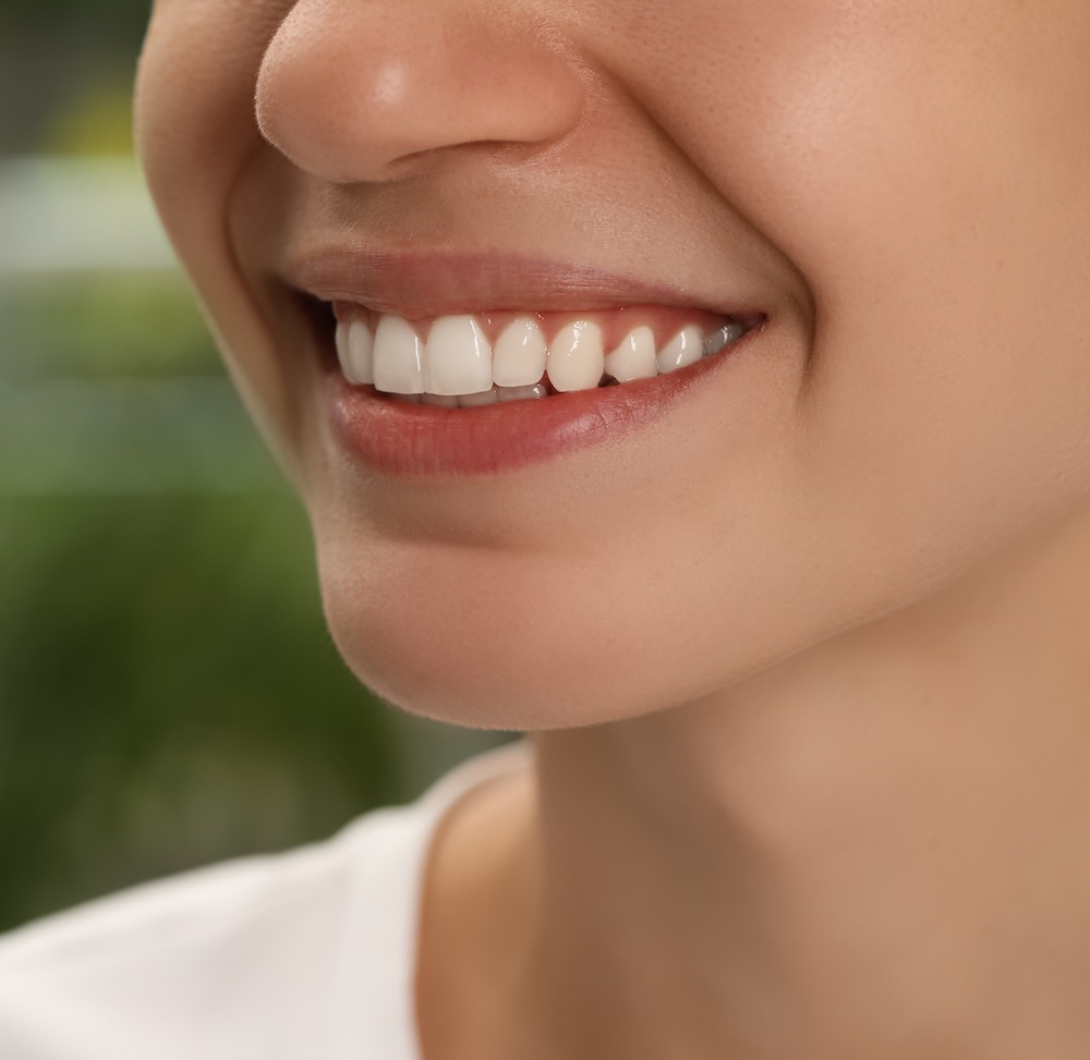 Diseño de sonrisa con carillas sin desgaste en Cancún, en iSmile Design Studio
