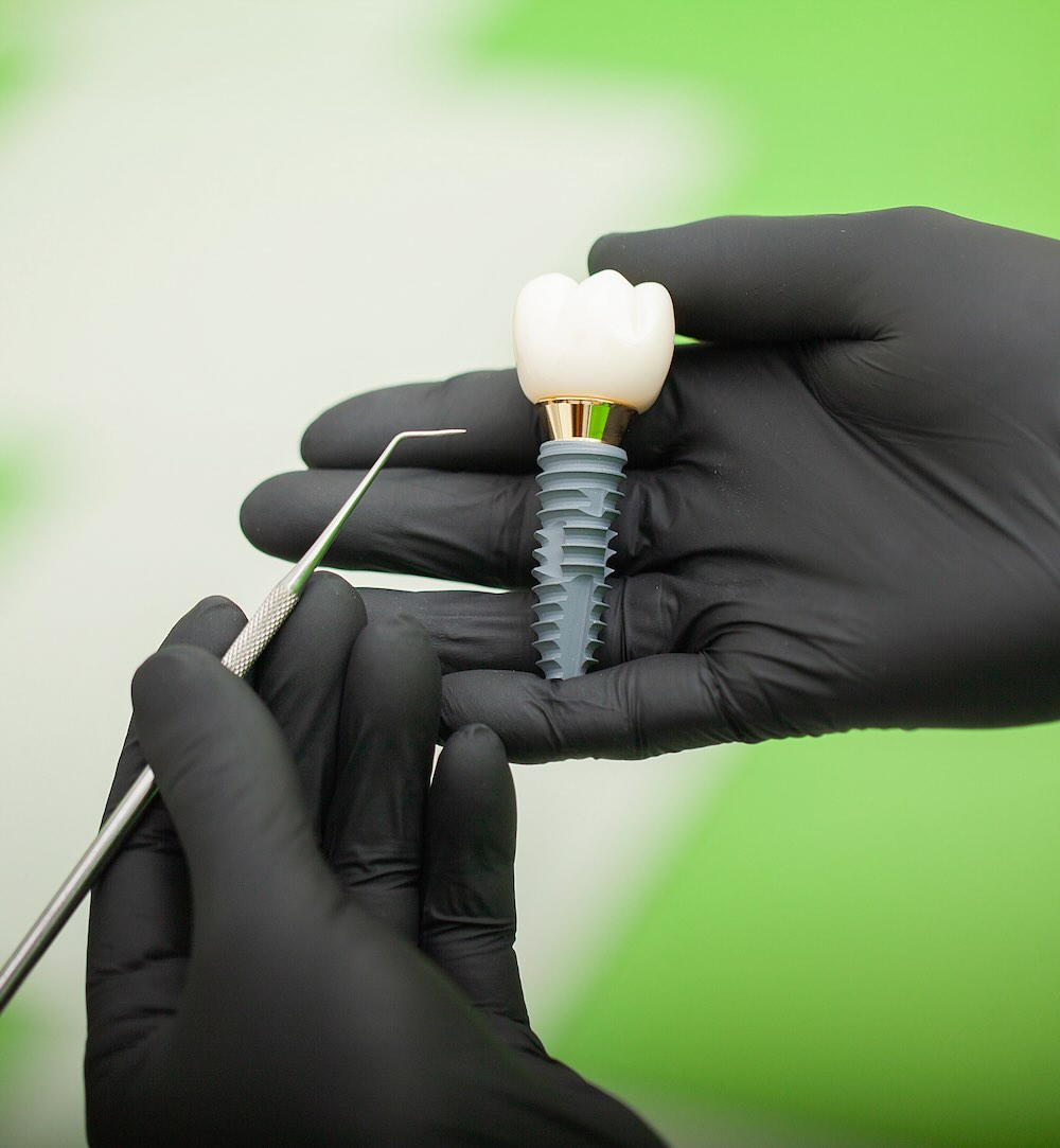 Implantes dentales en Cancún, iSmile Dental Design Studio