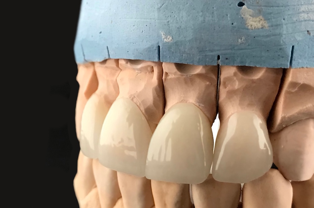 Rehabilitacion oral en cancun, en iSmile Dental Sesign Studio