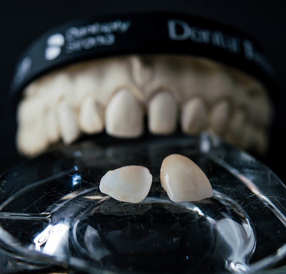 Diseño de sonrisa con carillas o coronas de zirconia en Cancún, en iSmile Dental Design Studio