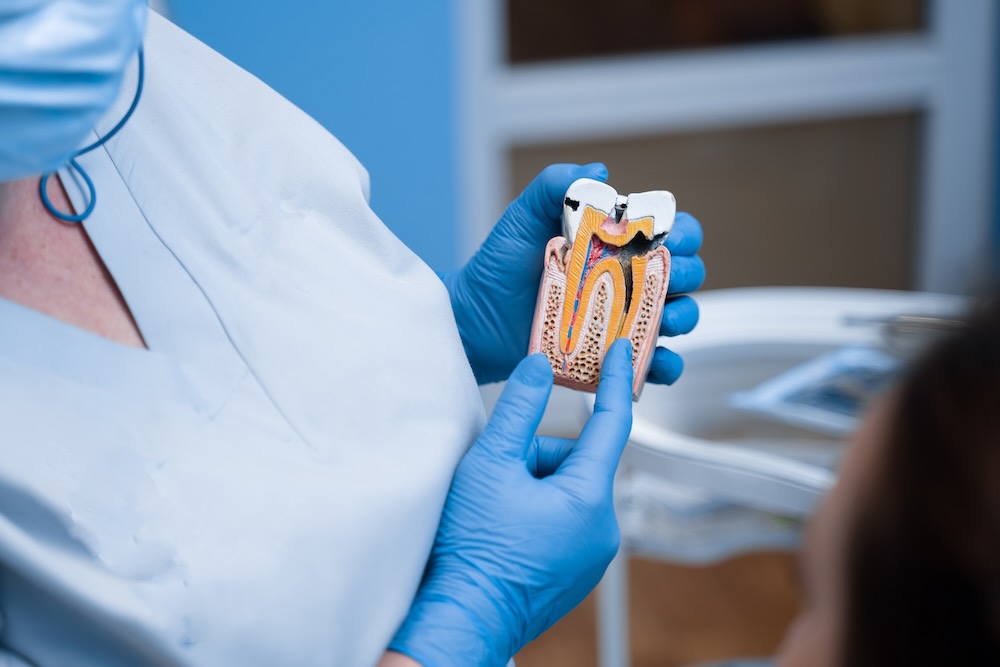 Endodoncia en Cancún en ismile Dental desing studio