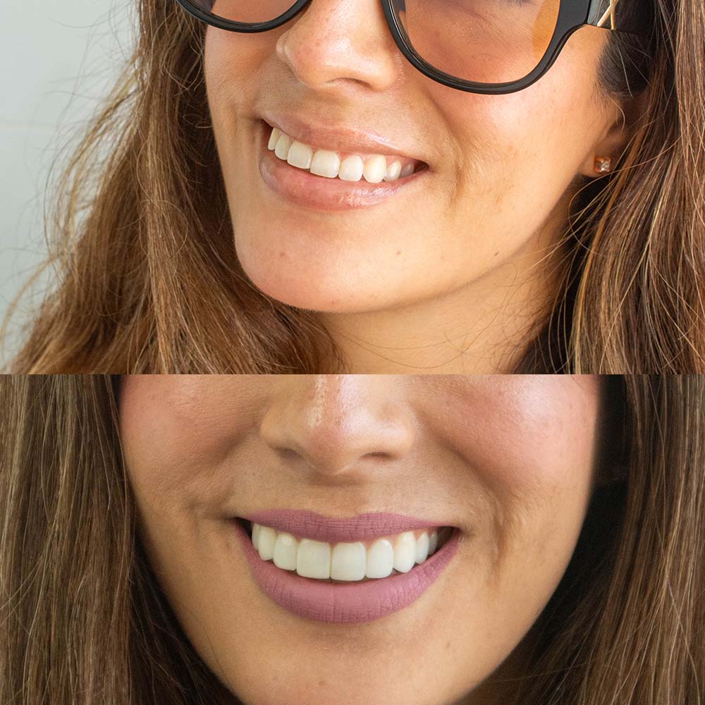 Sonrisa radiante y natural