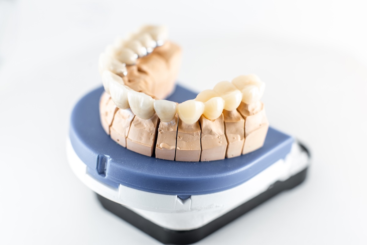 Coronas dentales de alta estética en Cancún, en iSmile Dental Design Studio