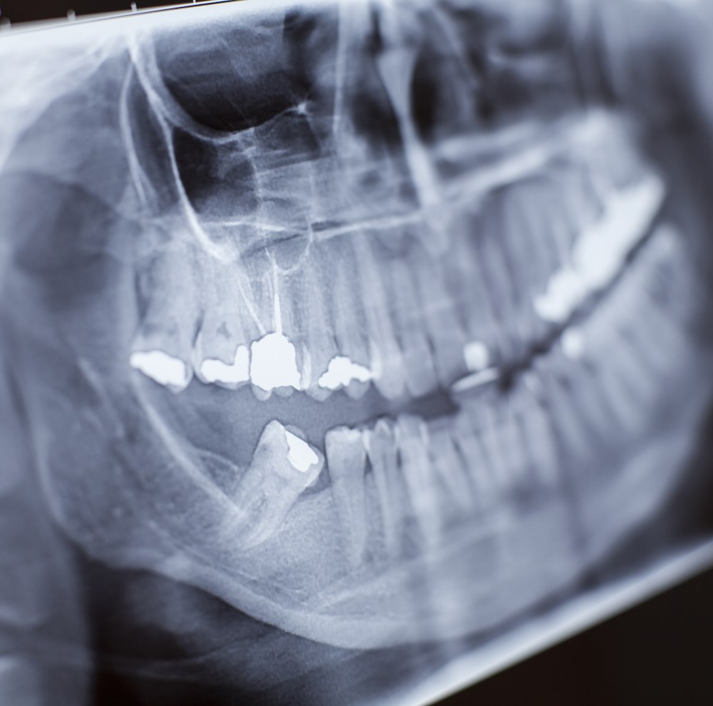 Extracción de muelas del juicio en Cancún, con iSmile Dental Design Studio