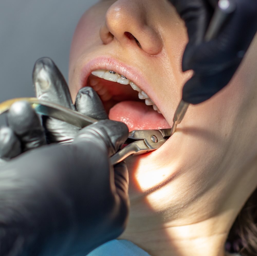 Extracción de terceros molares en Cancún, en iSmile Dental Design Studio