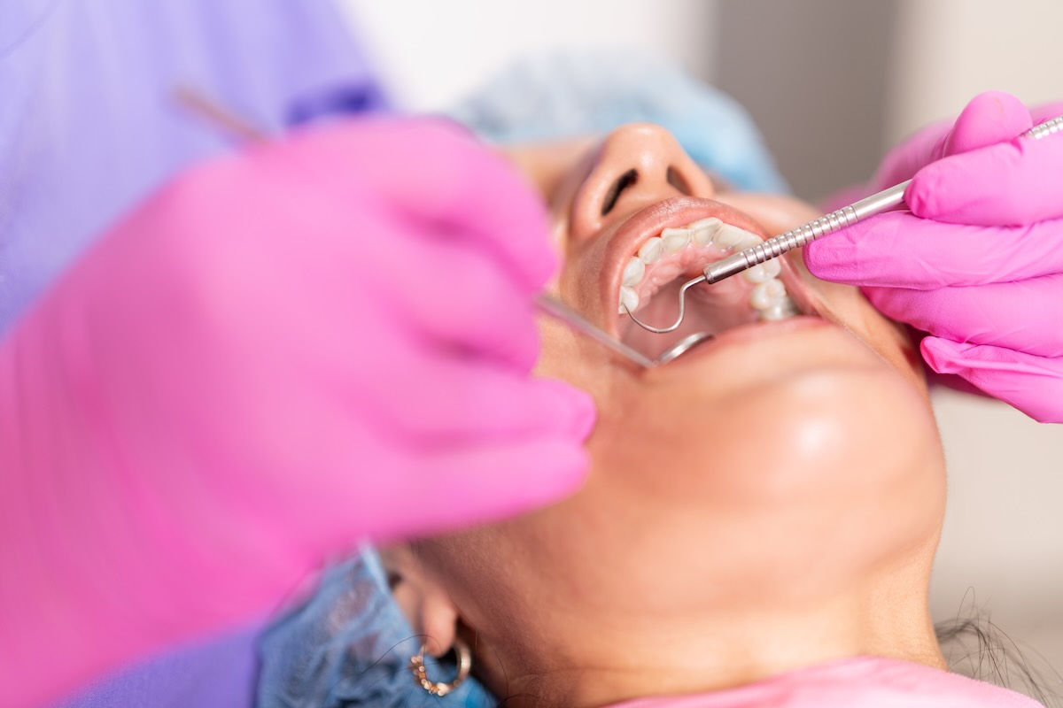 ¿Cuándo se recomienda una resina dental?